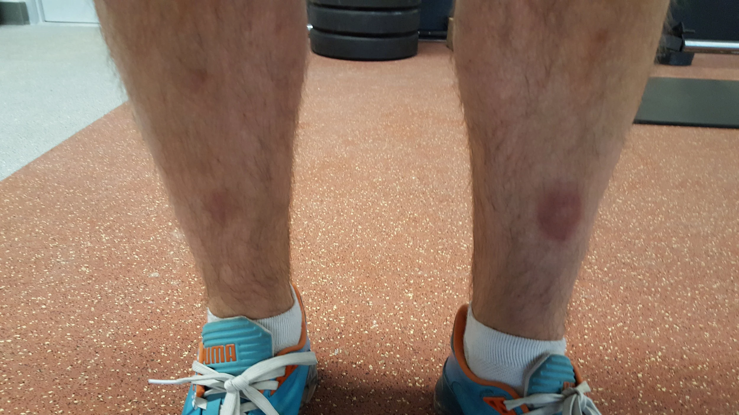 andrewshinbruises.jpg