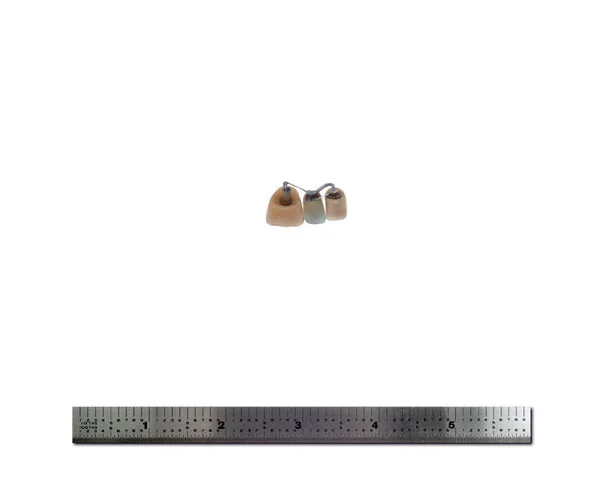 Dental Bridge Transceiver