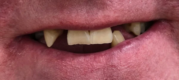 Before Partial Denture