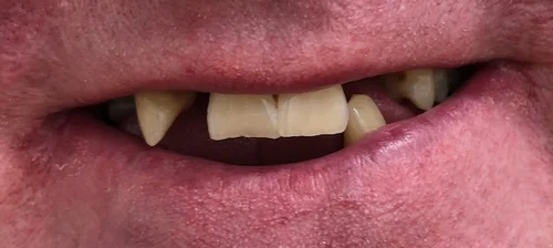 Partial Dentures Cost Price All Smiles Denture Clinic