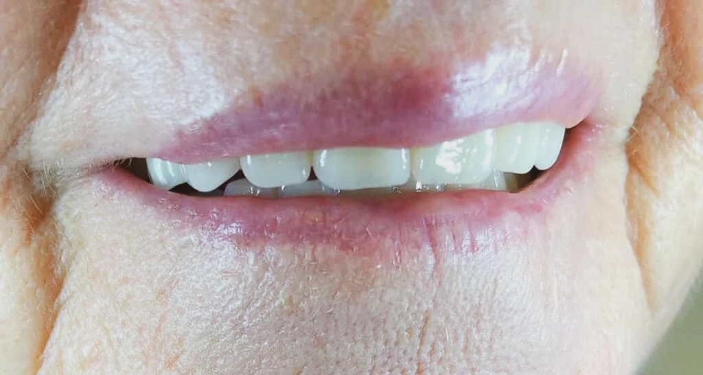 Why Don't My Dentures Fit? 