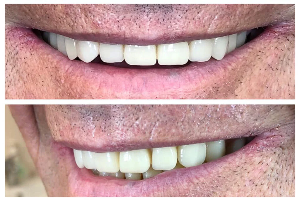 Sunshine Coast Denture Clinic - Denture Repairs