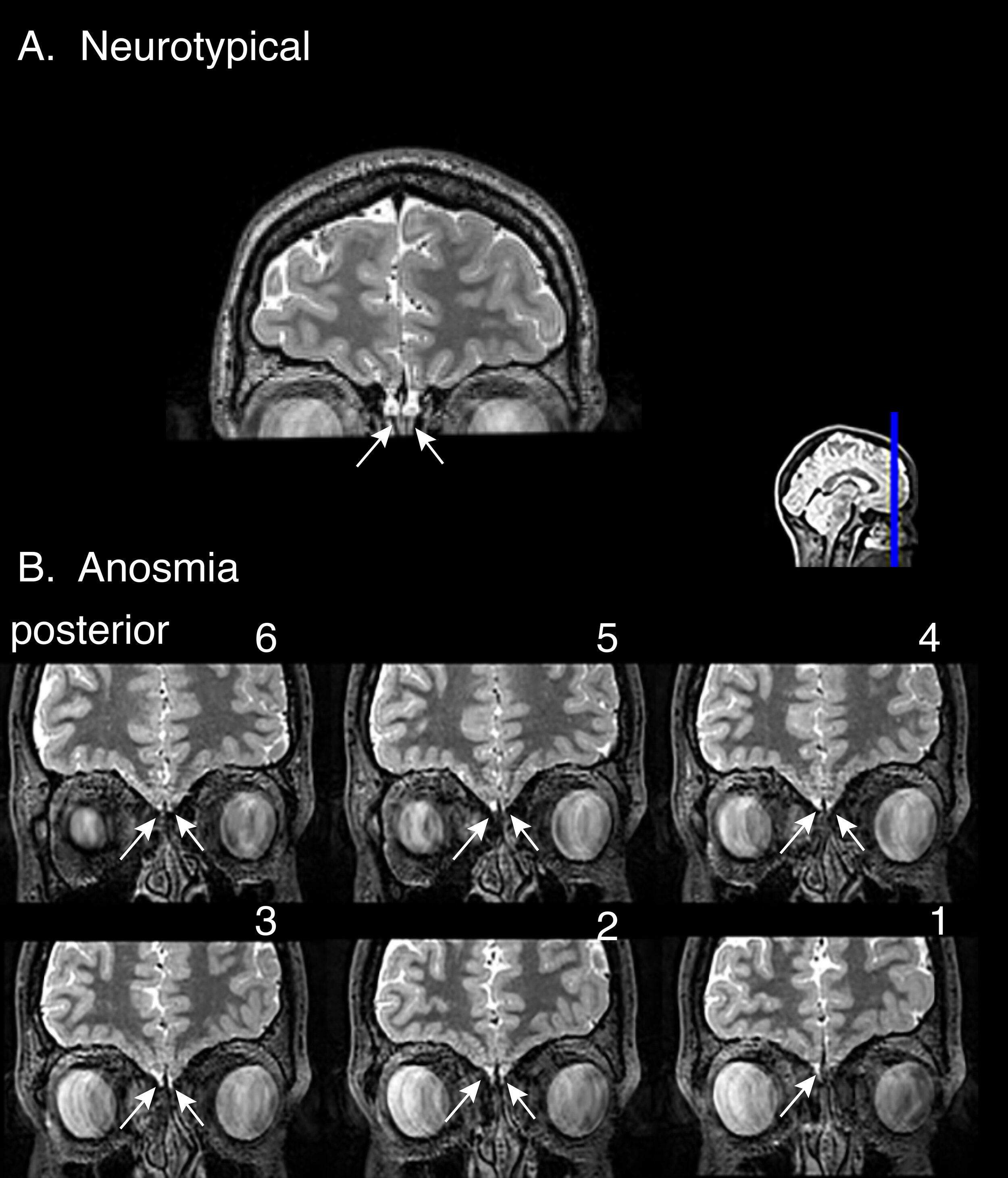 Fig1_MRI Coronal Arrayed.jpg