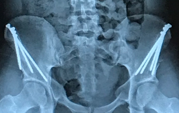 Figure 1: Four titanium screws secure the bones in their new position for a year after