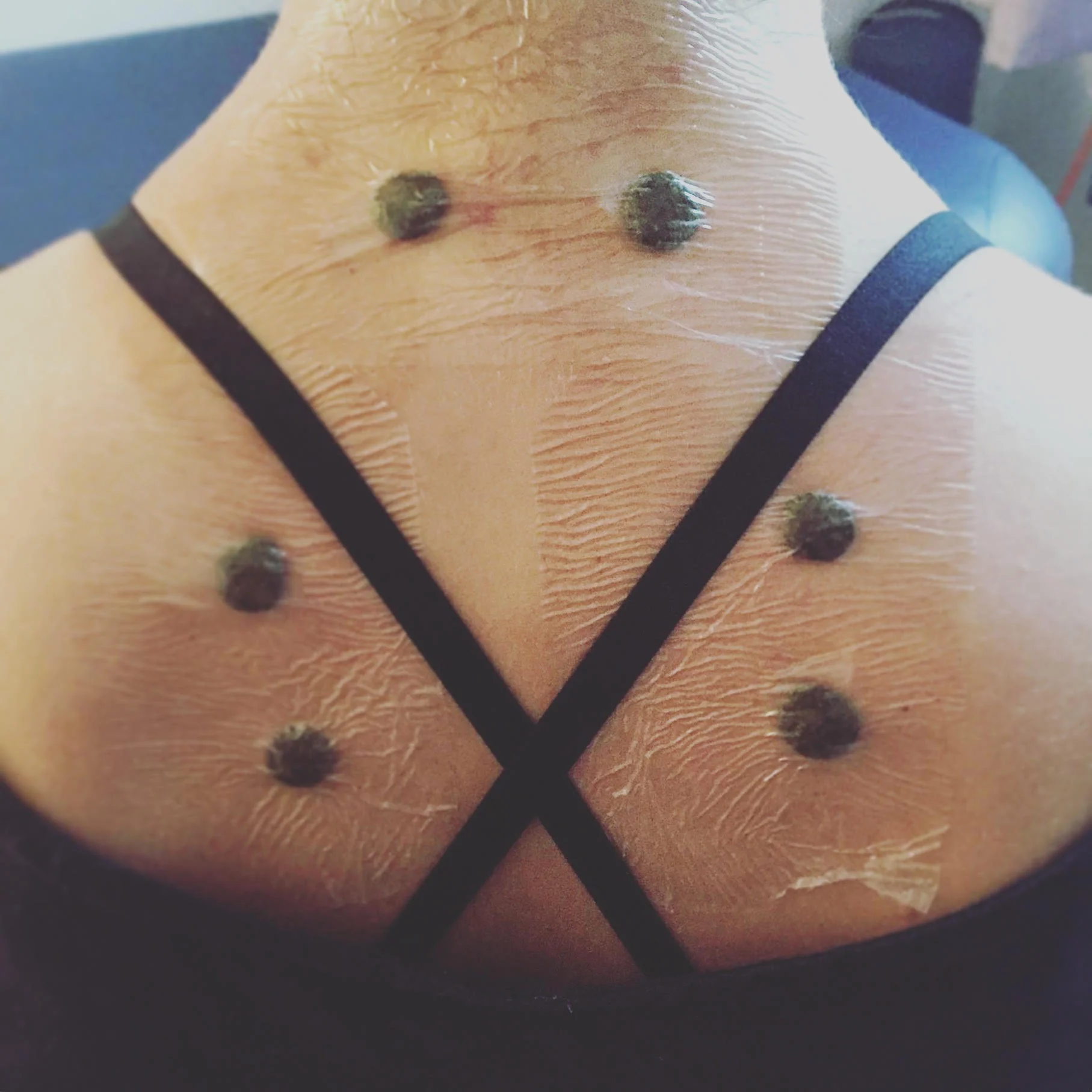 San Fu paste applied to the upper back