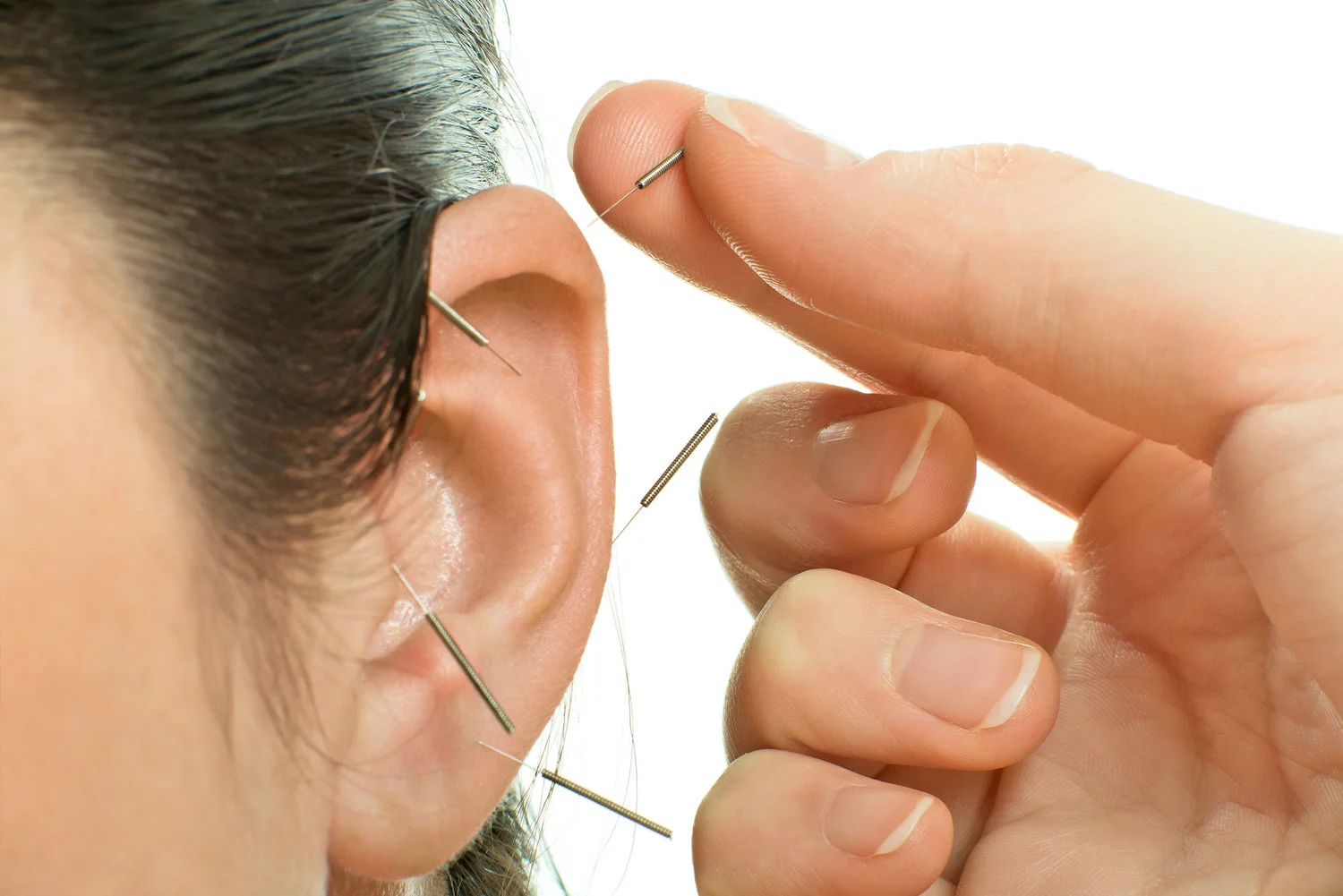 Are you stressed out? Try something different, ear acupuncture.