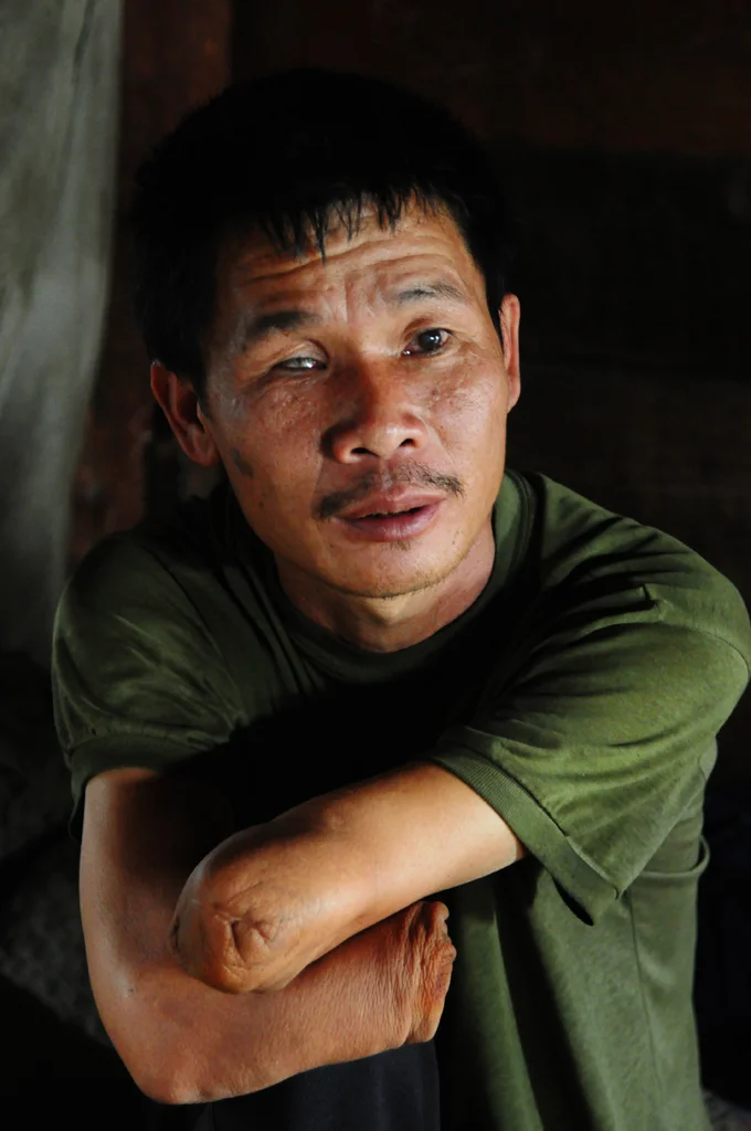 In 2004, Soung lost both his arms when a cluster munition exploded while attempting to collect the scrap metal for a lucrative profit. He has now lost his eyesight and considers himself a burden to his wife and five children. Xieng Khouang Province, Laos.