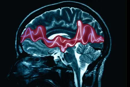 Narcolepsy is a sleep disorder that causes excessive sleepiness and frequent daytime sleep attacks.