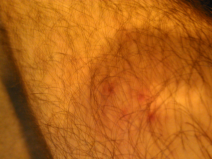 An image of the four yellow jacket stings on my knee. This yellow jacket may have been an artist in another life. It made a perfect diamond.