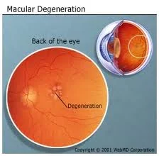 An eye with Macular Degeneration: Notice the black spot in the healthy eye is missing in the MD eye. Scar tissue has overtaken the macula. 