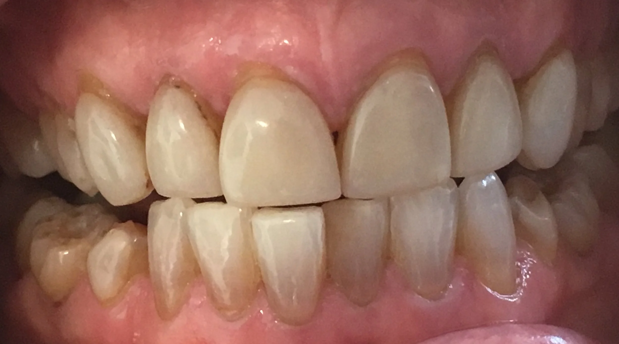 old veneer