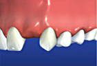 Bridges are prescribed for missing teeth.