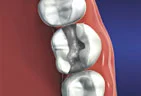 Filling materials is shaped to match the look and feel of natural teeth. Traditionally, silver or amalgam material has been the filling of choice.