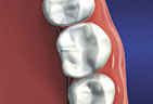 Today, many modern materials can be used to mimic the color and texture of natural teeth.