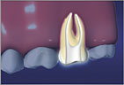 After creating a small opening, very small instruments are used to clean and shape the root canal spaces.
