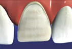 The tooth is prepared by eliminating surface structure