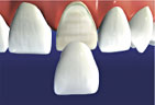 After fabrication the veneer is cemented to the prepared tooth