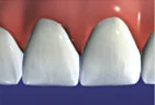 Veneers restore natural beauty and health of teeth