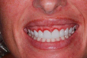 Improper use of a laser on the gum tissue destroyed the gingival 
attachment. A painful and costly mistake. Periodontal gum surgery was 
needed to correct error, followed by new veneers.​