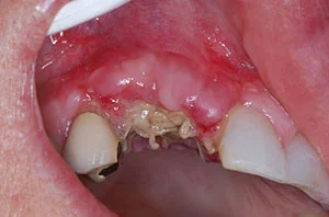 Huge extraction socket, failed bone graft, necrotic bone and tissue held in place by sutures.