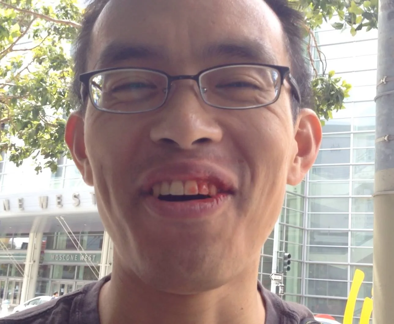 Punched in the face at a demonstration in May 2014, but still smiling! 