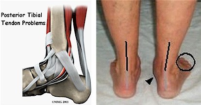 Flat Foot / Posterior Tibial Tendonitis | Travis J. Kemp, M.D. | Boise, ID