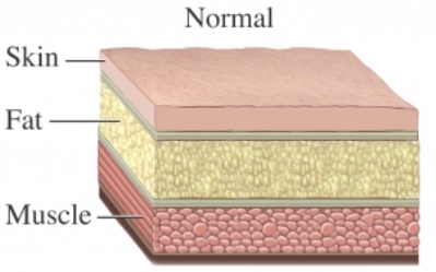 Subcutaneous fat lives in the layer between muscle and skin. A large layer of fat will hide the appearance of muscles. But just because you increase muscle mass, doesn't necessarily mean you decrease fat at the same time.