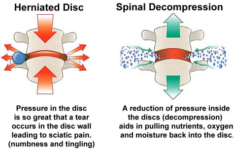 Non-Surgical Spinal Decompression - Healthy Life Chiropractic