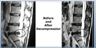 Notice the x-ray on the left, showing a herniated/bulging disc. The x-ray on the right is of the same spine after non-surgical spinal decompression therapy.