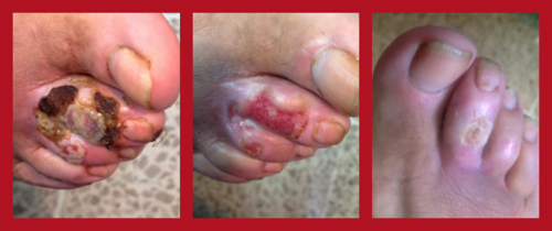 Diabetic patients are frequently encountered. Many of them are prone to infection and foot problems, sometimes because of improper fitting of shoes, abrasions, irritation, and even cuts and bruises from a lack of footwear while walking barefooted along trails, through brush and tall vegetation or traversing unpaved roads and fording rocky rivers and streams. A patient’s toe before, six days, and 25 days after topical hyperbaric oxygen therapy.
544x376
Normal
0
false
false
false
EN-US
JA
X-NONE
/* Style Definitions */
table.MsoNormalTable
{mso-style-name:"Table Normal";
mso-tstyle-rowband-size:0;
mso-tstyle-colband-size:0;
mso-style-noshow:yes;
mso-style-priority:99;
mso-style-parent:"";
mso-padding-alt:0in 5.4pt 0in 5.4pt;
mso-para-margin:0in;
mso-para-margin-bottom:.0001pt;
mso-pagination:widow-orphan;
font-size:10.0pt;
font-family:"Times New Roman";}