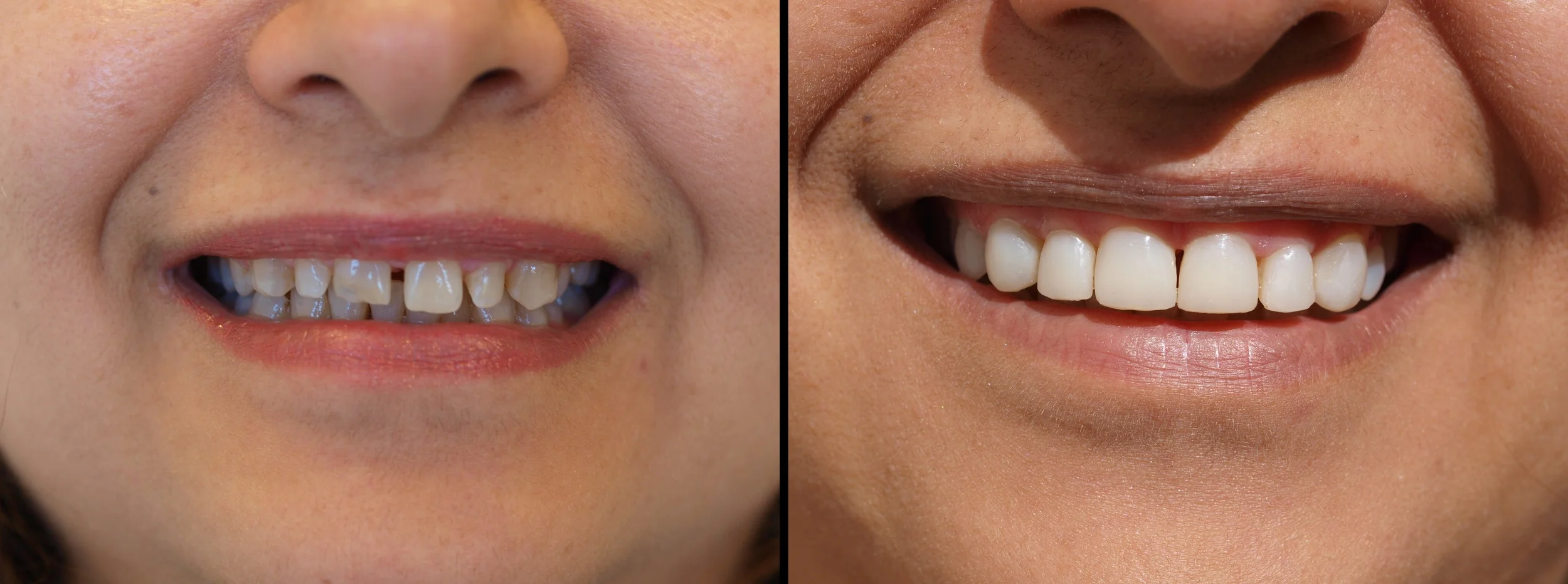 Veneers