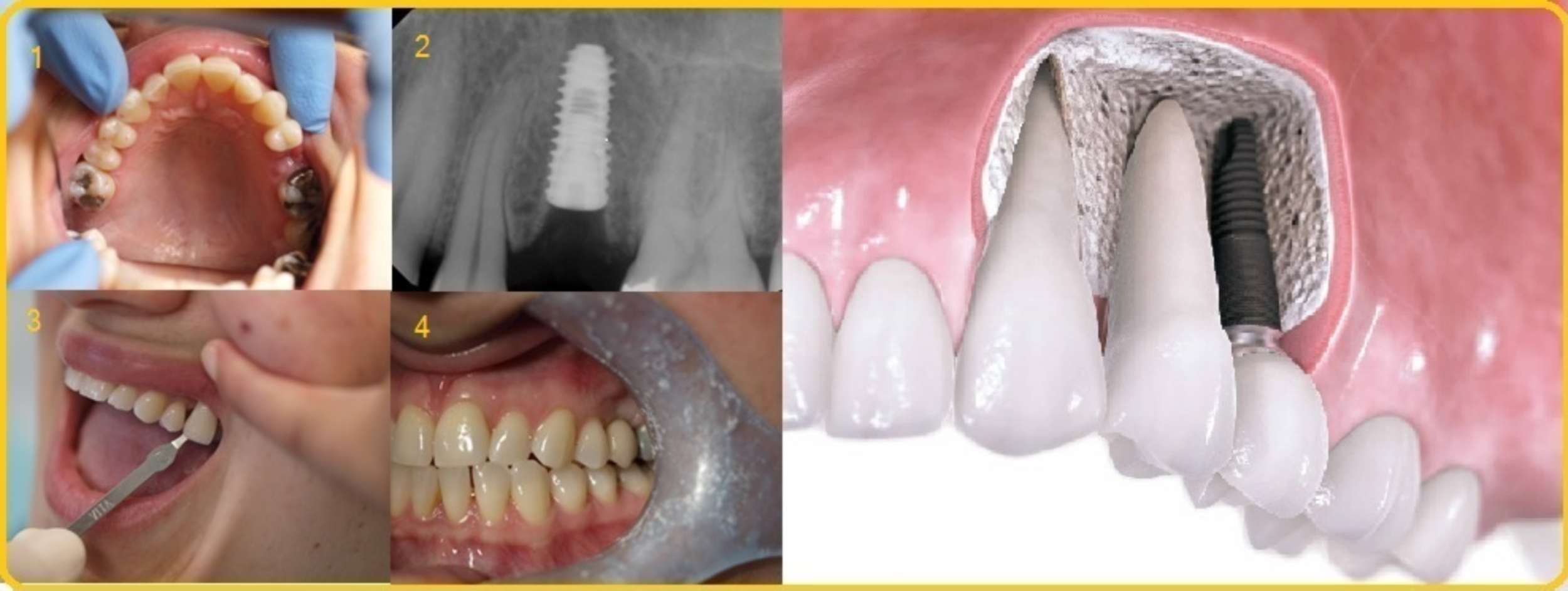 Implants