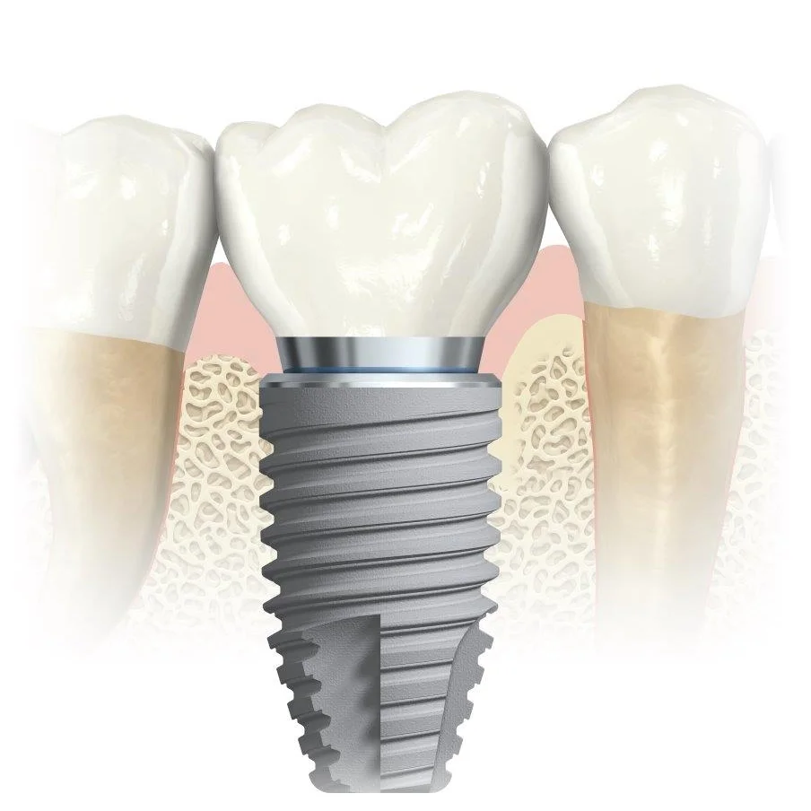 single-dental-implant-bundoora-1.jpg