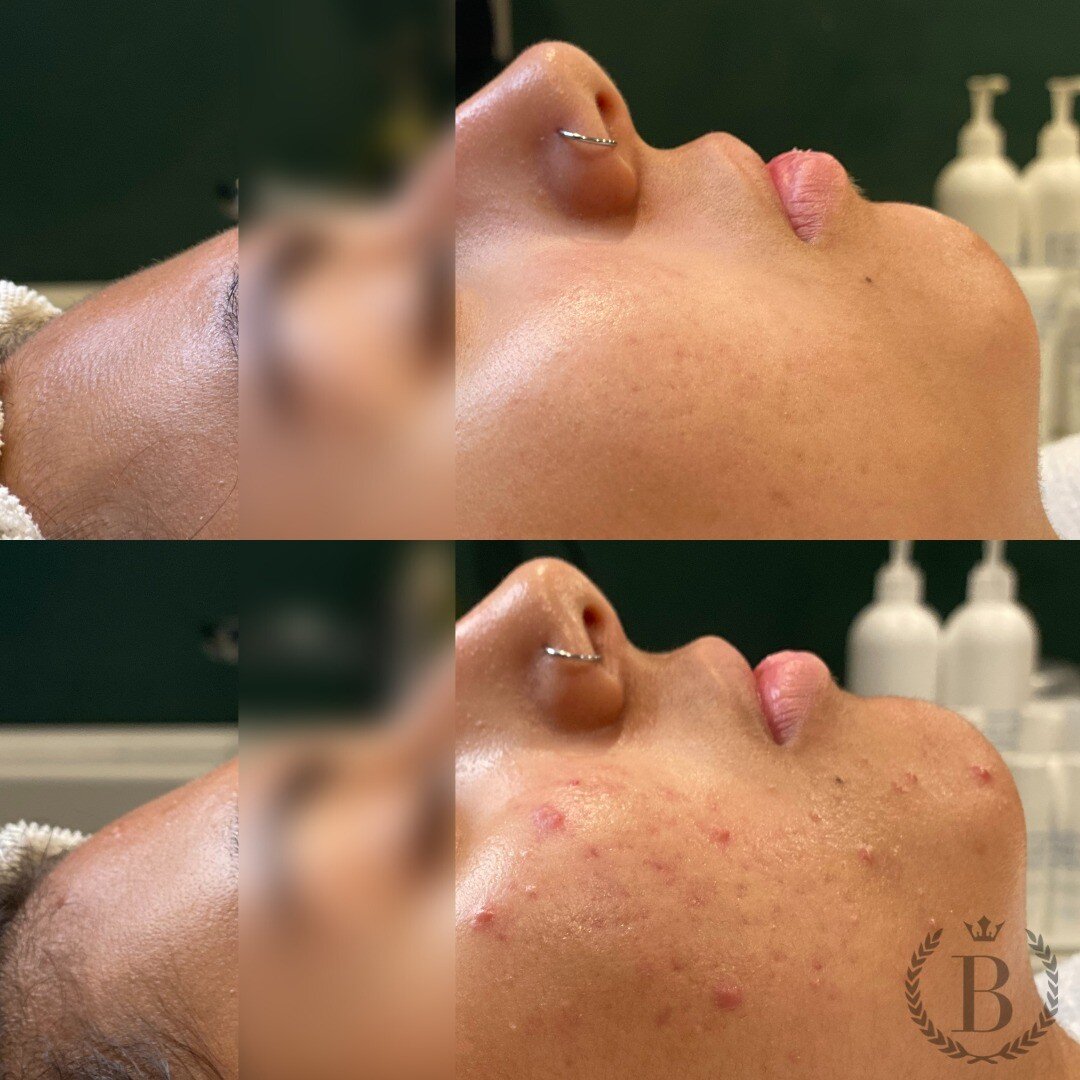 Is it magic? Filters? Photoshop?

Nope, just another glowing Face Reality client pre and post acne treatment protocol!

Not sure if an acne treatment regimen is right for you? Call or go online to book a consultation! 

#skinbyhana