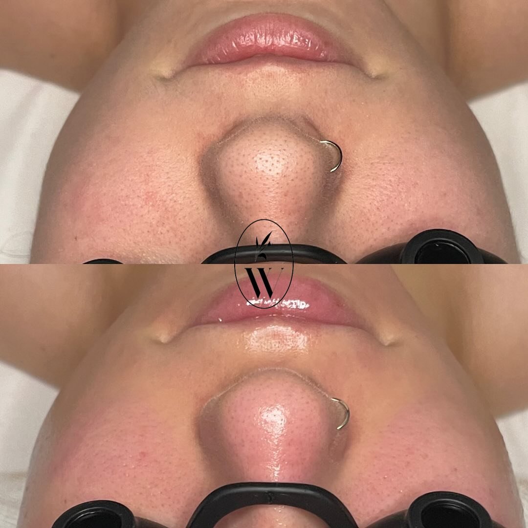 From congested to clear 🫧

Congested and/or enlarged pores are a common skin concern we get asked about all the time. While we are all born with a certain pore size, external and internal factors can influence how they show up on the skin. It&rsquo;