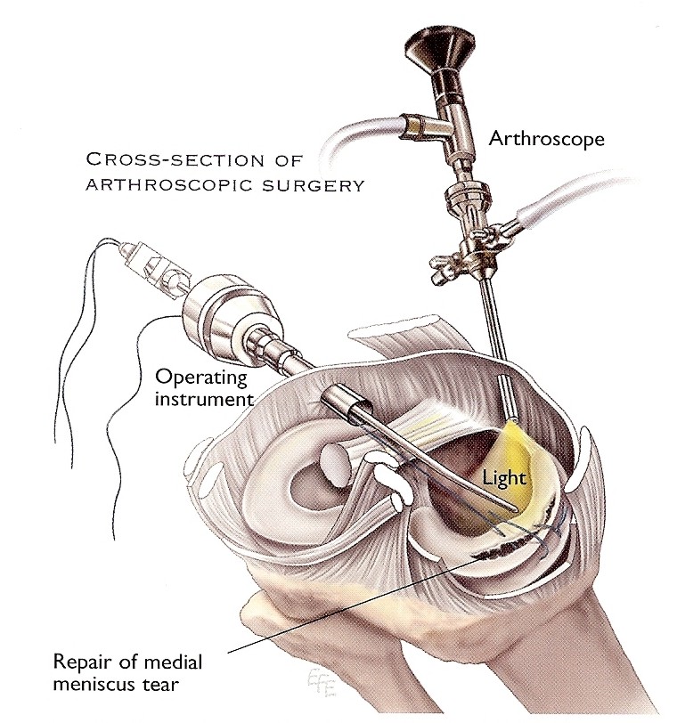 Arthroskopischer Eingriff: Reparatur eines gerissenen Meniskus