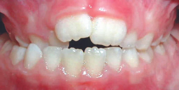 Crossbite