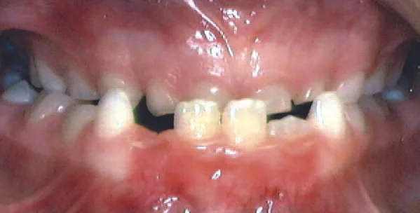 Underbite