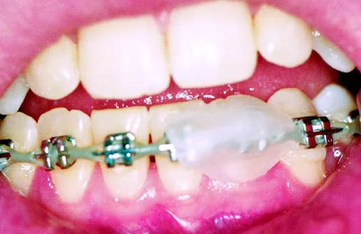 orthodontic braces problems sore lips gums
