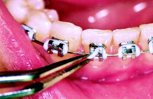 braces problems ligature piece falls off