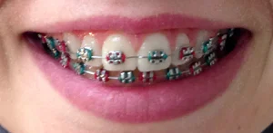 bronx braces