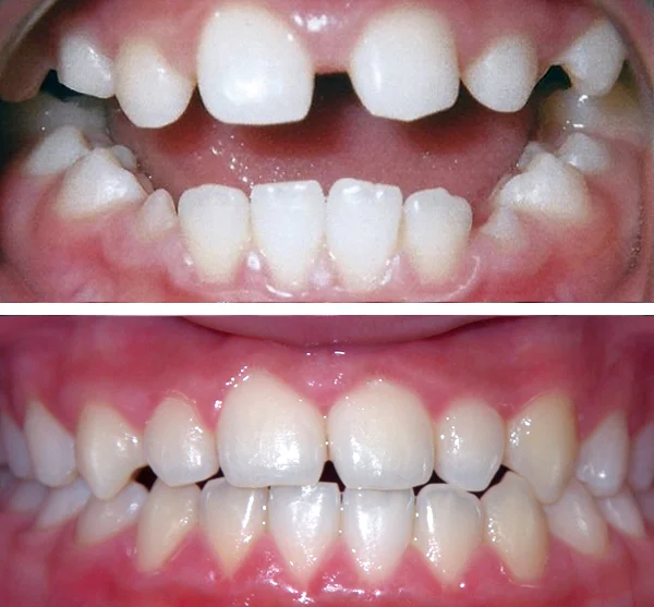 forest hills braces before and after