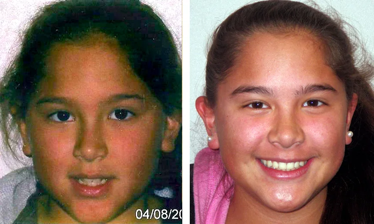 queens invisalign patient