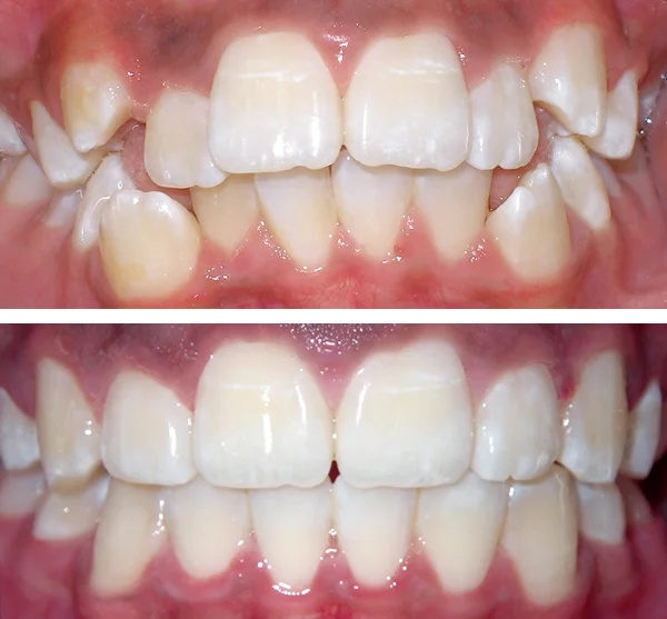 bronx braces before and after
