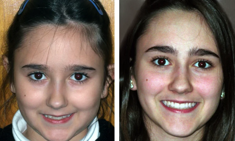 queens braces before and after