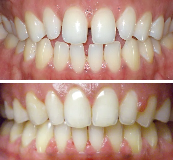 norwood invisalign before and after