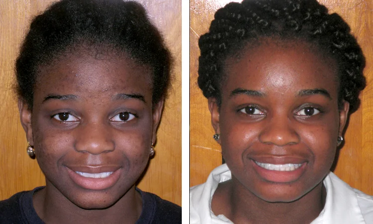 queens orthodontist before and after