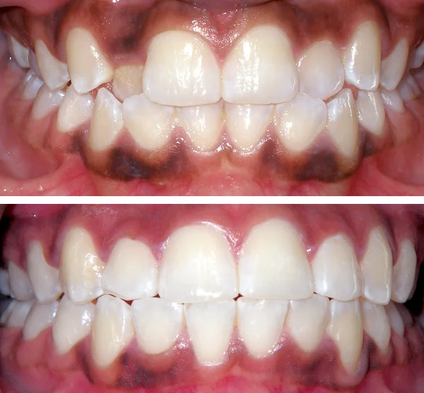 queens ny invisalign before and after