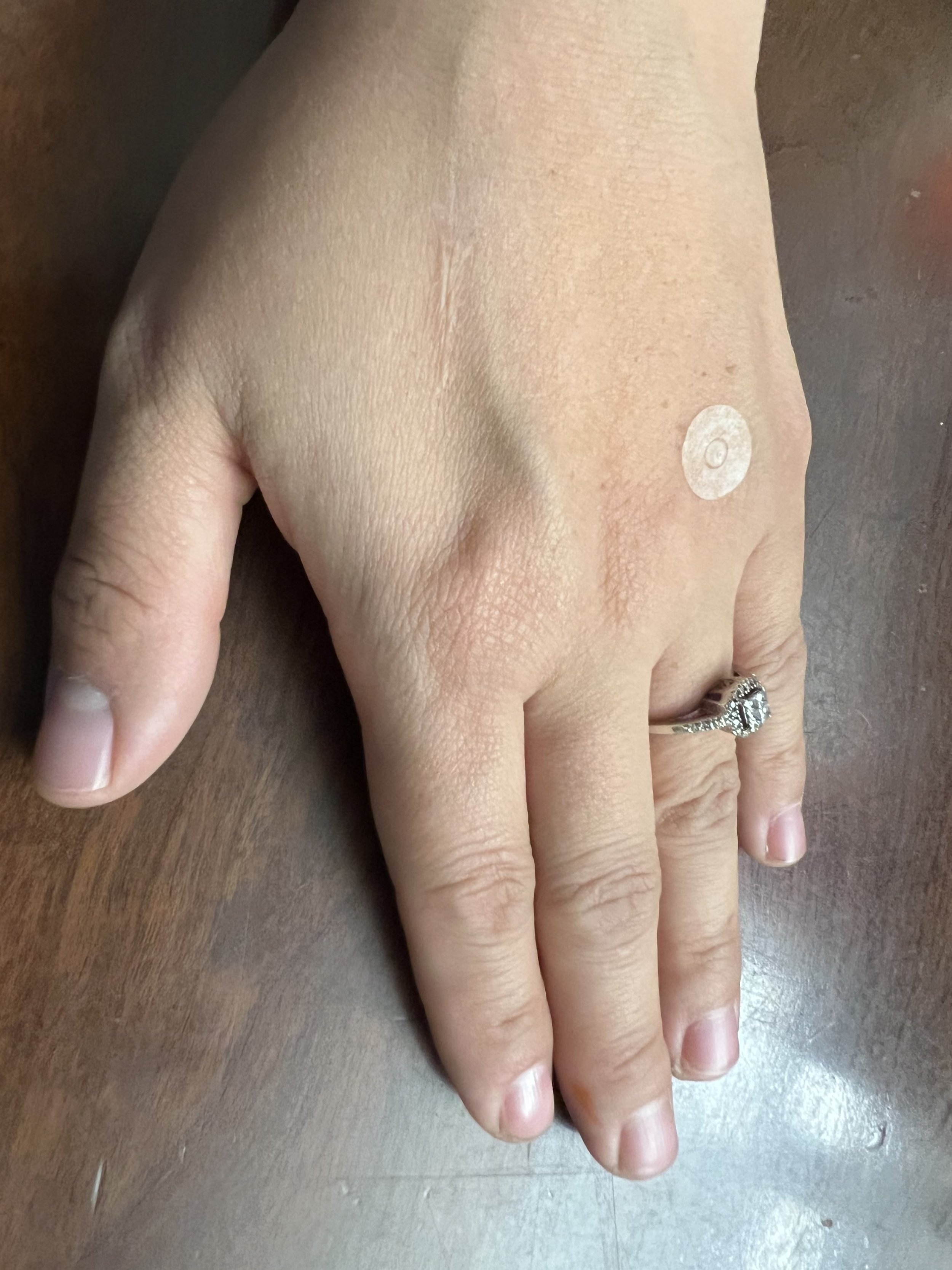 a Seirin transdermal needle on a hand