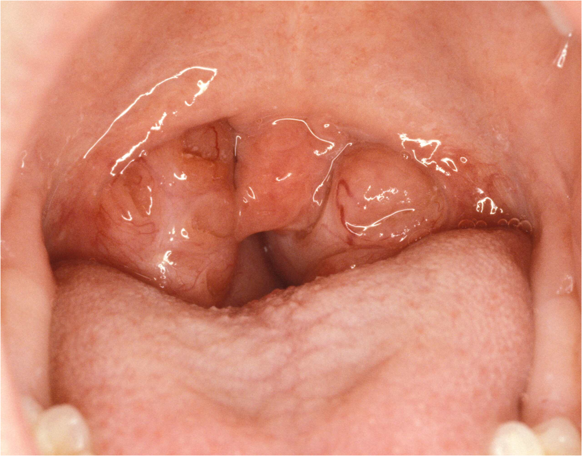 Enlarged tonsils